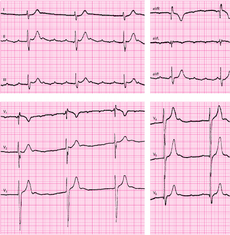 EKG görbe