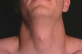 Az ádámcsutka kidudorodása egy férfi nyakon