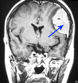 Agydaganat MRI felvételen