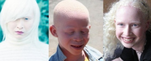 Albinizmusban szenvedő gyerekek