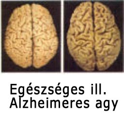 Alzheimeres és az egészséges agy felvétele