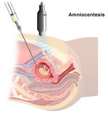 Amniocentézis