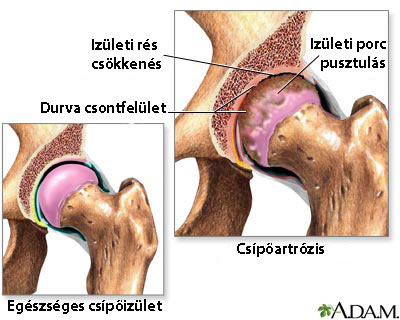 Csípőartrózis