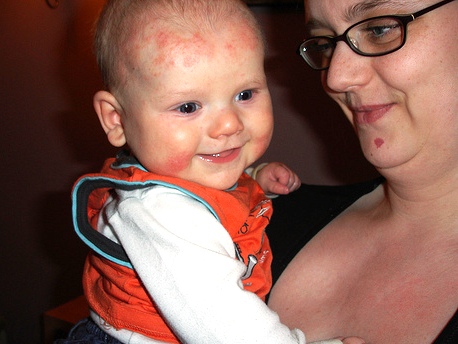 Atópiás dermatitisz egy gyermeken