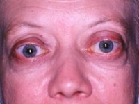 Basewos-kór tünete a kidülledt szem