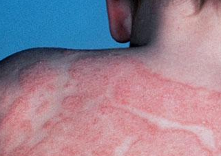 Bőrgombásodás- kórokozók támadása a bőrön