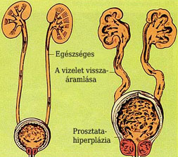 Prosztata megnagyobbodás