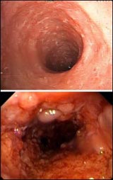 Crohn betegség tünete a végbéltályi tályog és fekély