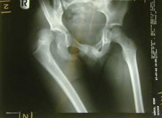 Csípőficam röntgenképen