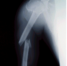 Törött csont egy röntgenfelvételen