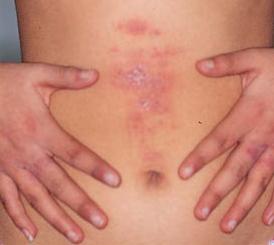 Dermatitisz tünete a gyulladt bőr