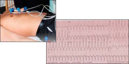 EKG