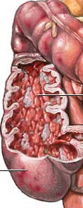 Fekélyes vastagbélgyulladás- a vastagbél nyálkahártyájának pusztulása, vérző fekély jelenik meg rajta