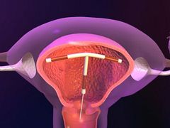 Méhen belüli fogamzásgátló eszköz