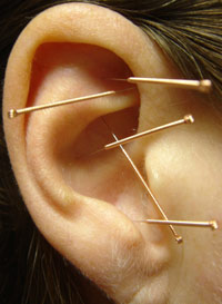 Fülakupunktúra - a fül bizonyos pontjainak stimulálása