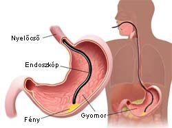 Gasztroszkópia