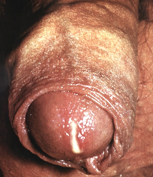 A gonorrhoea egyik tünete a férfiaknál a gennyes folyás a péniszből.