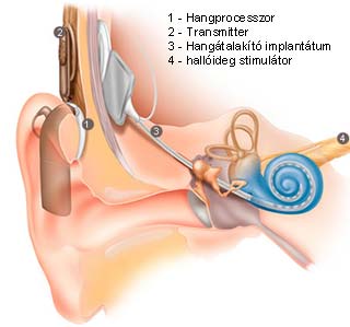 Hallásjavítás implantátummal