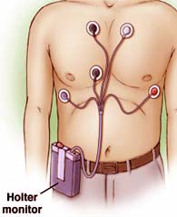 Holter vizsgálat