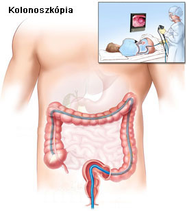 Kolonoszkópia