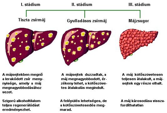 Májbetegség stádiumai