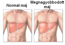 Megnagyobbodott máj