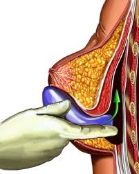 Implantátum mellizomzat alá helyezése