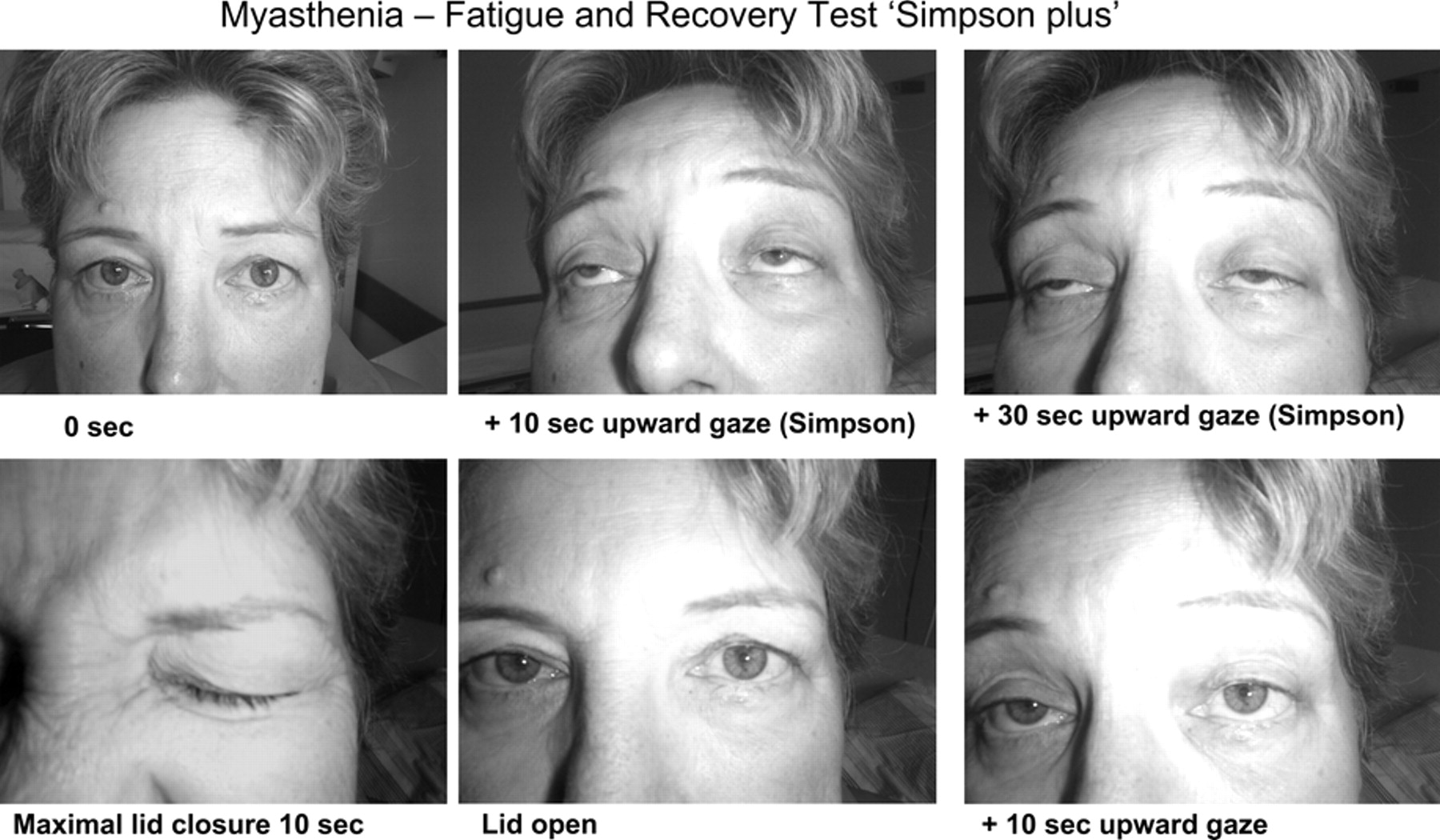 Myasthenia gravis betegségben szenvedő beteg 