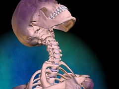A nyaki gerincszakasz rándulása