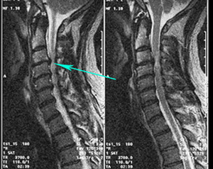 Nyaki porckorongsérv MRI felvételen