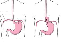 Reflux- az elfogyasztott étel gyomorsavval együtt visszajut a nyelőcsövünkbe