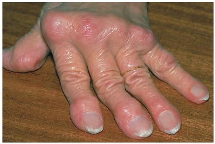 rheumatoid arthritis