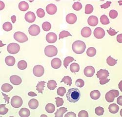 Thrombocytopenia