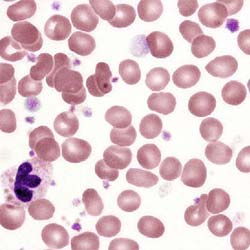 Thrombocytosis