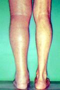 Mélyvénás trombózis tünete a megdagadt láb