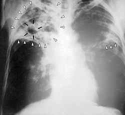 Tuberkulózis - fertőző tüdő betegség