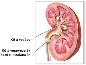 Vesekő a vesében